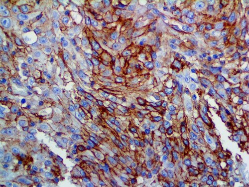IHC of Thrombomodulin on an FFPE Mesothelioma Tissue